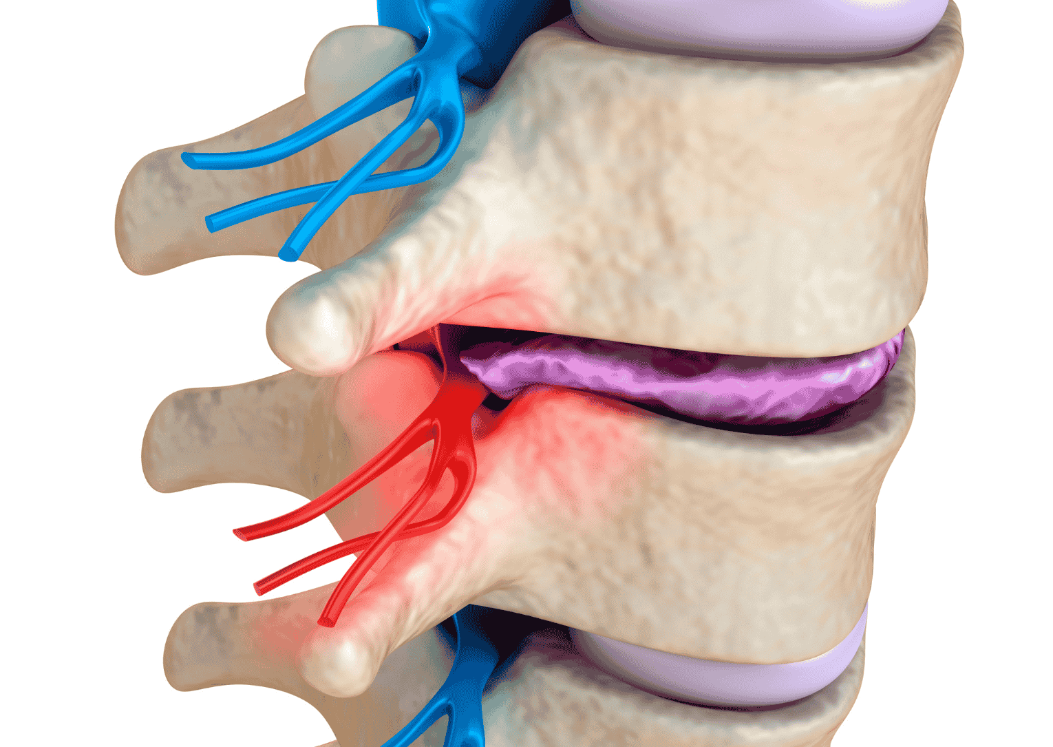 Bulging Discale: Cause, Sintomi e Trattamenti Fisioterapici e Chirurgici